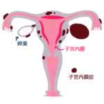 子宮内膜症のイラスト