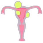 子宮筋腫のイラスト